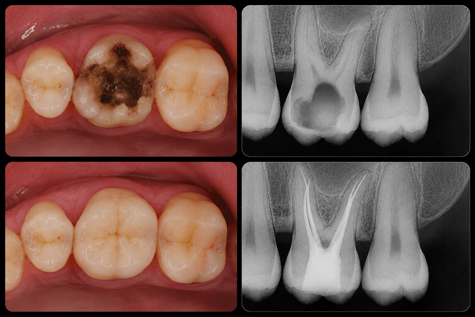 Painless Root Canal Treatment